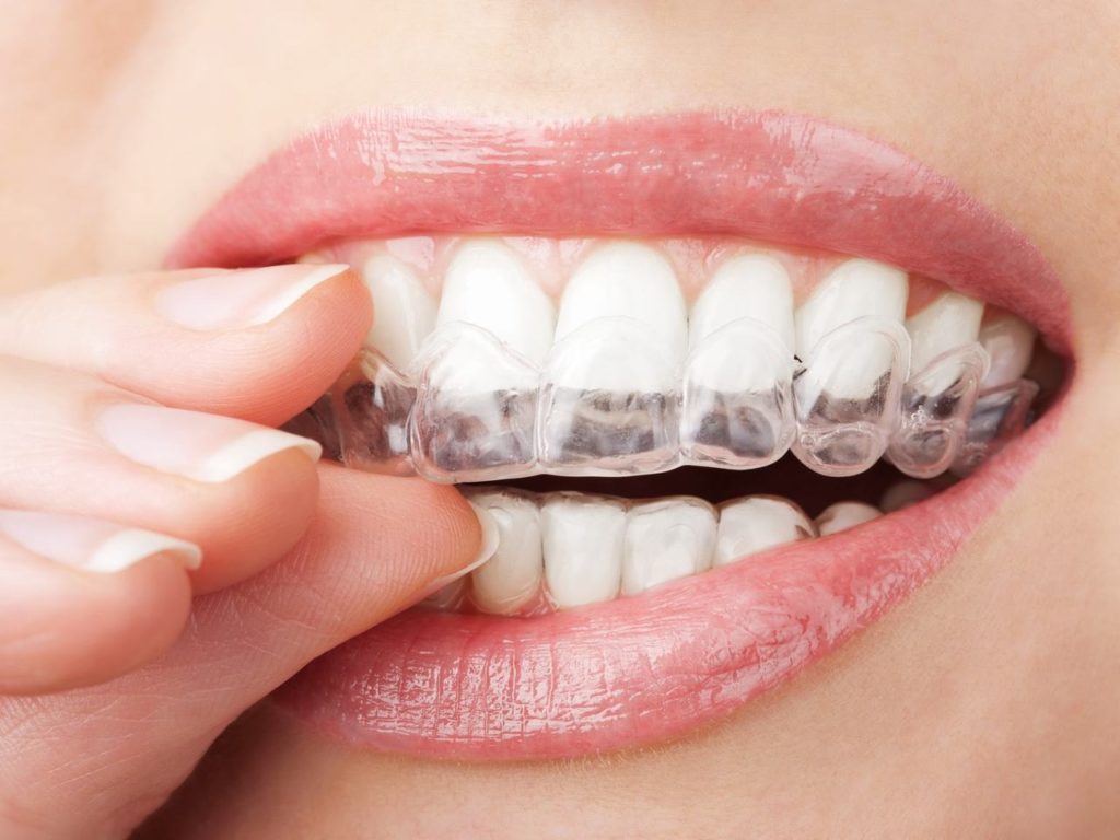 The Real Cost Of Teeth Whitening