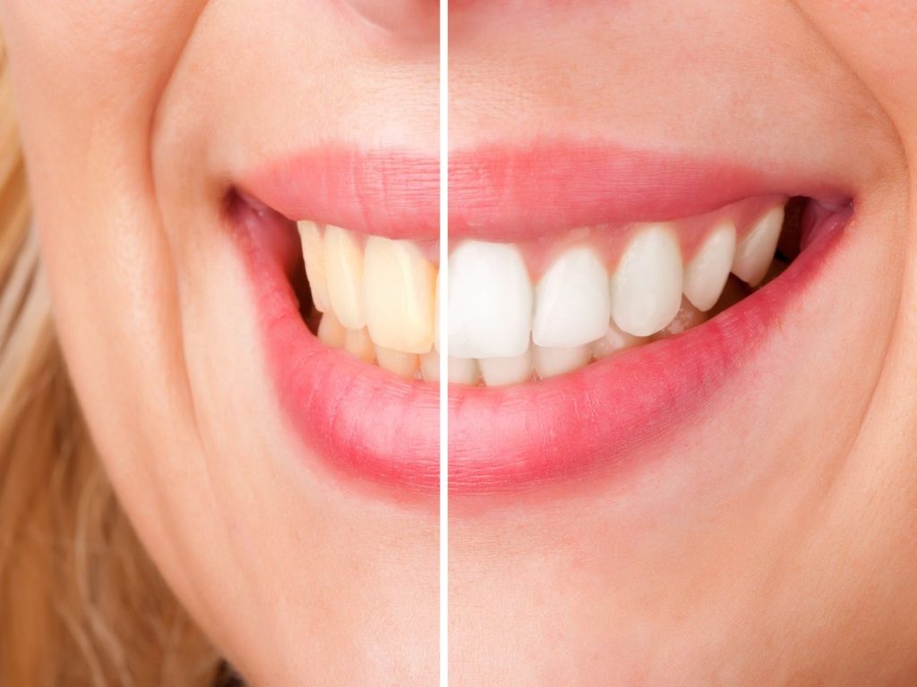 Home Remedy: Teeth Whitening Methods